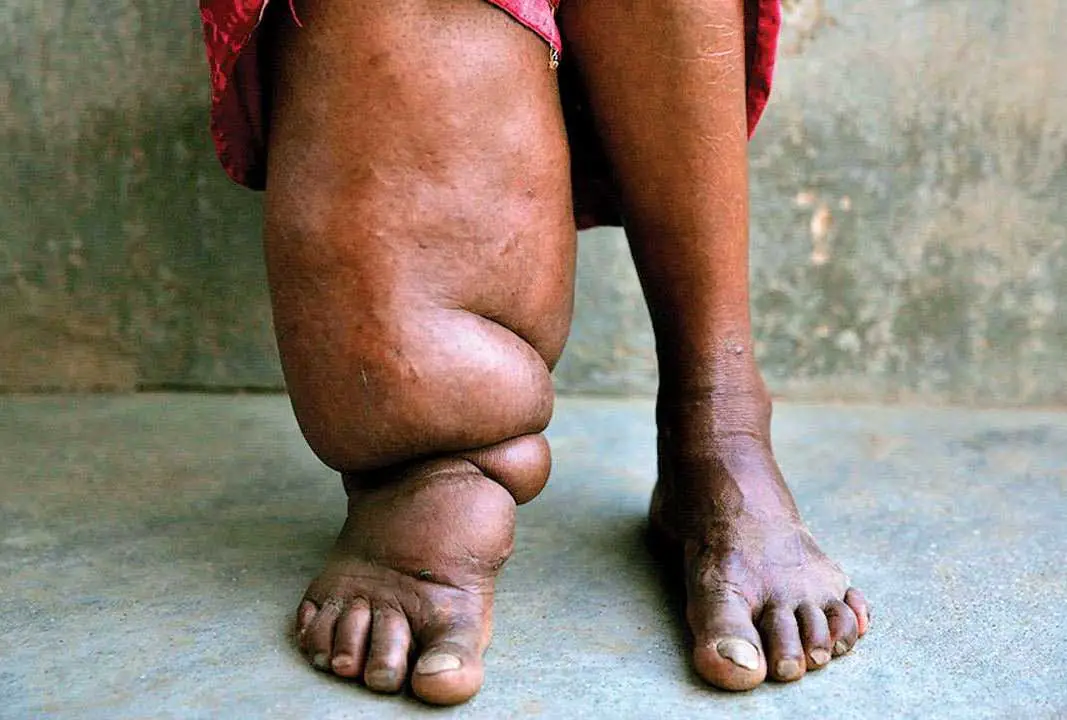 image of Elephantiasis