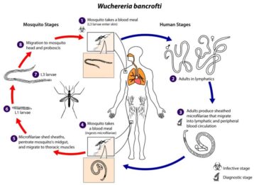 Wuchereria bancrofti: Morphology, Life Cycle and Pathogenesis | Biology ...